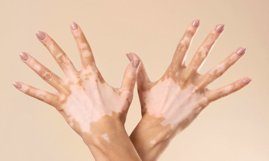 Vitiligo