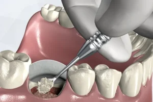 Bone Graft Gigi